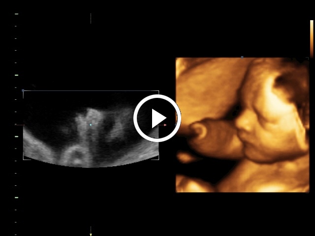 saját 4d ultrahang videófelvétel, SonoAce R7-tel készítettük